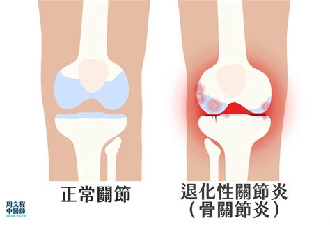 退化性關節炎骨關節炎是什麼 了解成因、檢查及治療方式 2024版 周文程中醫師