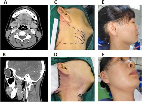 Benign Submandibular Gland Tumours Outcomes Of Gland Preserving