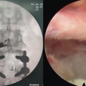 Intraoperative Fluoroscopic Images Showing Direct Decompression Under