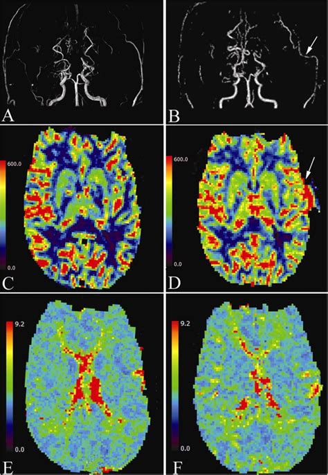 Predicting Cerebral Hyperperfusion Syndrome Following Superficial