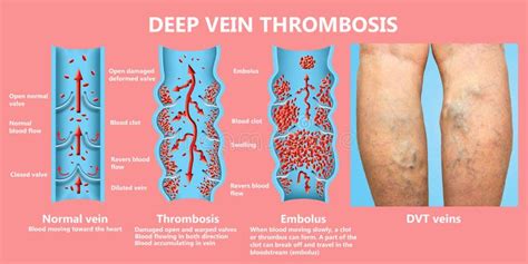 Deep Vein Thrombosis Or Blood Clots Embolus Stock Image Image Of