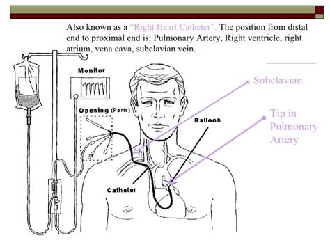 Swan Ganz Catheter Diagram