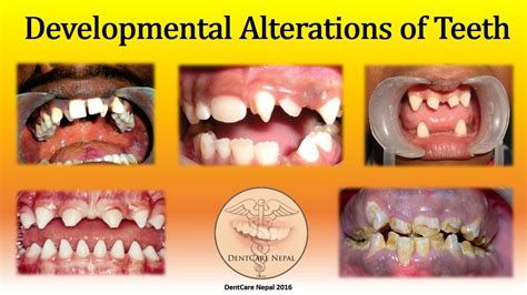 Developmental Defects Of Teeth Oral Pathology YouTube