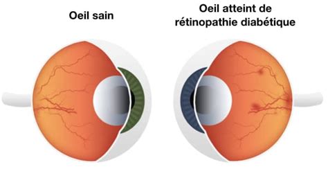 Rétinopathie diabétique traitement définition Dr Butel Ophtalmo Paris