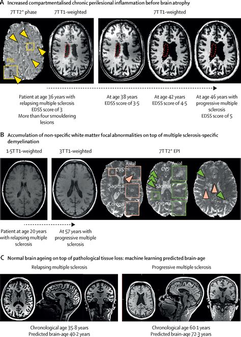 Ageing And Multiple Sclerosis The Lancet Neurology