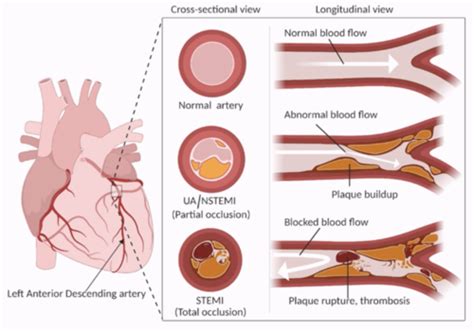 Acute Coronary Syndrome Unstable Angina Nstemi Stemi Flash NBKomputer