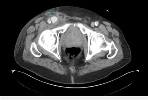 Computed Tomography Scan Of The Pelvis Showing Pseudoaneurysm Of The