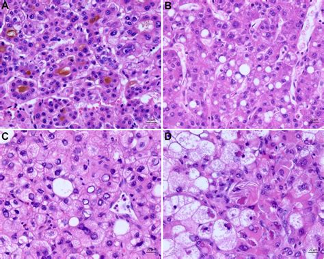 Histopathology Of Hepatocellular Carcinoma When And What