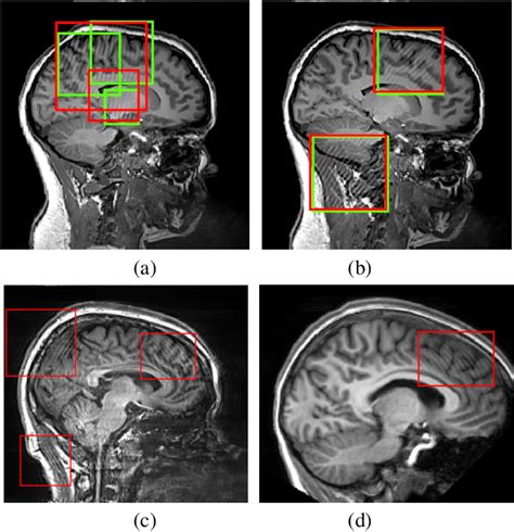 Figure From Localized Motion Artifact Reduction On Brain Mri Using