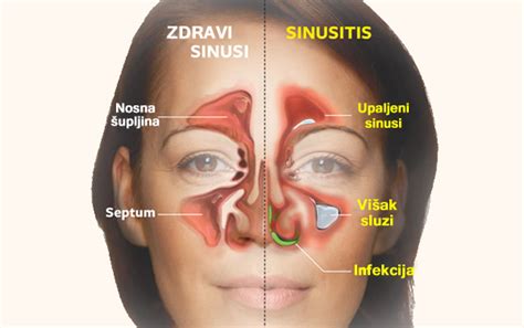 Sinusna Zubobolja Kako Sinusi Izazivaju Zubobolju Stomatologija