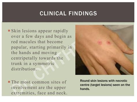 Erythema Multiforme Dr Chithra P Ppt