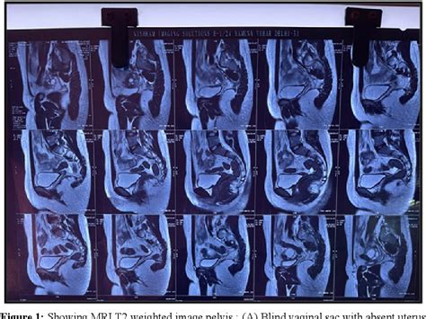 Figure From Mayer Rokitansky Kuster Hauser Syndrome Mrkh Syndrome