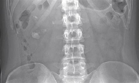 Plain Abdominal Radiograph Demonstrating Asymmetric Renal Calculi This