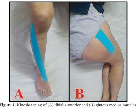 Figure 1 From The Effectiveness Of A Novel Kinesio Taping Technique On