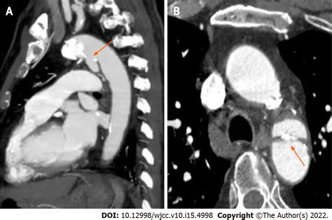 Blunt Aortic Injury Traumatic Aortic Isthmus Pseudoaneurysm With Right Iliac Artery Dissection