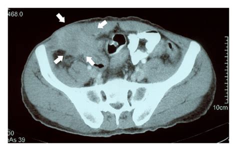 A The First Ct Of The Patient Before Neoadjuvant Chemotherapy Thick Download Scientific