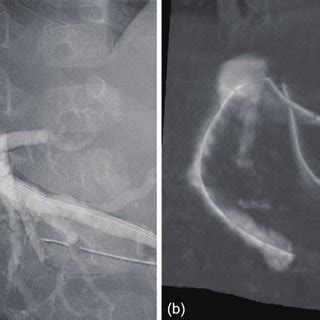 A Cholangiogram Shows The Occluded Bile Duct Anastomosis Of B