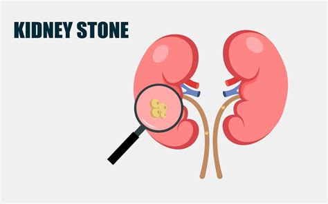 Kidney Stone Symptoms Causes And Treatment Healthy Seed