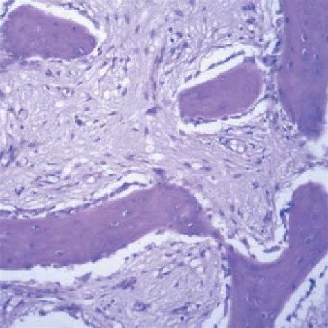 Fibroma óseo Juvenil Neoformación De Tipo Mesenquimal Constituida Por Download Scientific