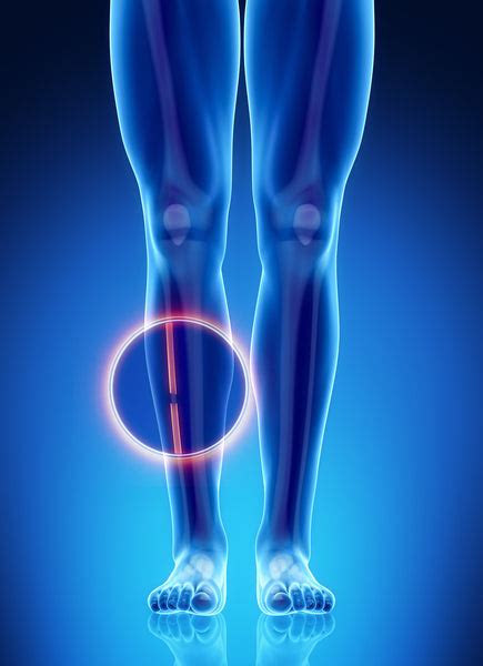 Fractures of the Fibula | Injuries| KneeRover