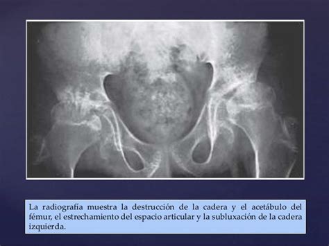 Artritis Idiopatica Juvenil