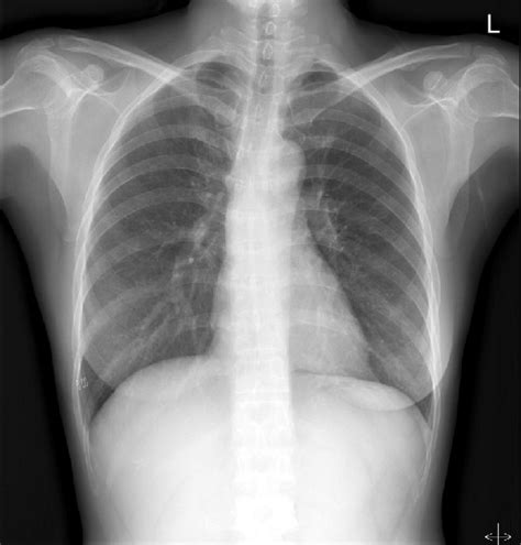 Follow up chest PA X-ray shows resolution of the pneumo media stinum ...