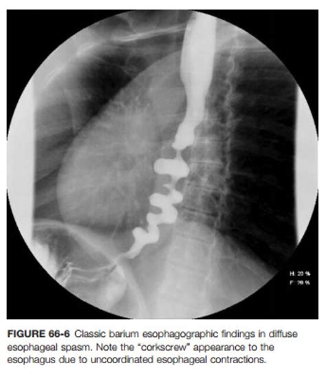 DES Barium Swallow Diffuse Esophageal Spasm Corkscrew Barium