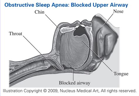 Obstructive Sleep Apnea Blocked Airway National Institute Of Justice