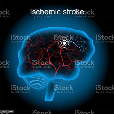 Infark Serebral Stroke Iskemik Otak Manusia Ilustrasi Stok Unduh