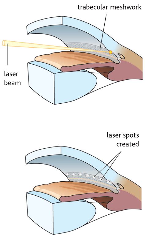 Argon Laser Trabeculoplasty/Selective Laser Trabeculoplasty - North Fulton Eye Center