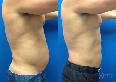 Before And After Photos Airsculpt® Elite Body Sculpture