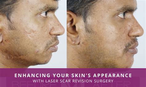 Laser Scar Revision Surgery Enhancing Your Skins Appearance