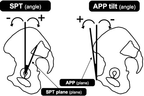 Anterior Pelvic Plane Tilt APP Tilt And Spino Pelvic Tilt SPT The