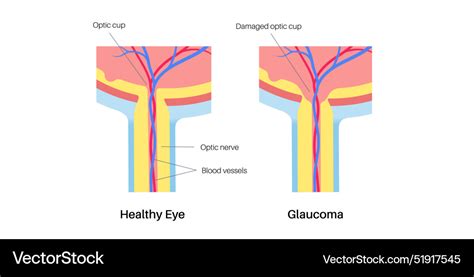 Damaged optic cup Royalty Free Vector Image - VectorStock