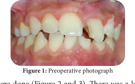 Figure 1 From Non Surgical Management Of Large Periapical Cyst Like