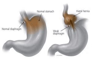 Hiatal Hernia Surgery Overview - Santa Monica, CA & Encino, CA