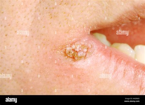 Common Cutaneous Warts Or Verrucae Vulgaris Generally Appear On Stock