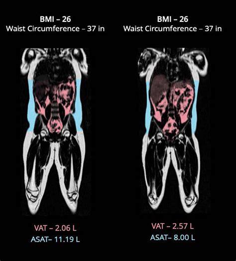 Body Composition Profile With Mri Mayfair Diagnostics