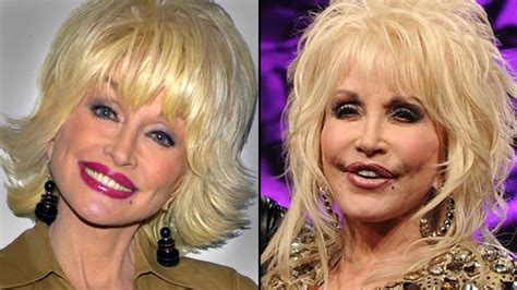 Chatter Busy: Dolly Parton Facelift | Celebrity surgery, Celebrity ...