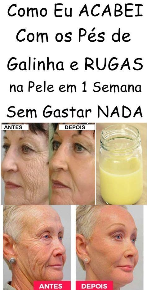 Como Eu Acabei Os P S De Galinha E Rugas Na Pele Em Semana Sem