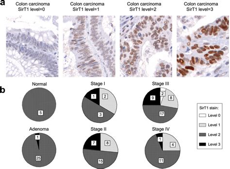 SirT1 Expression Is Heterogenous In Adenocarcinomas Human Colon Tumor