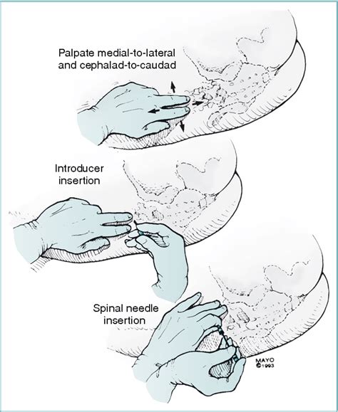 Figure 12-10 from Spinal, Epidural, and Caudal Anesthesia: Anatomy ...