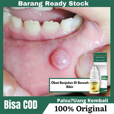 Jual Obat Benjolan Di Bawah Bibir Sariawan Mucocele Abses Gusi