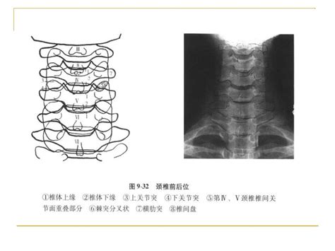 颈椎x线诊断 平高医院康复科 赵铎 Ppt Download