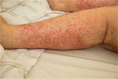 The Rash That Becomes Purpuric Petechial Hemorrhagic Or Ecchymotic