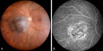 Choroidal Melanoma Fluorescein Angiography