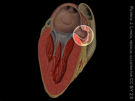 Laa Closure Tied To Better Heart Surgery Outcomes Medpage Today