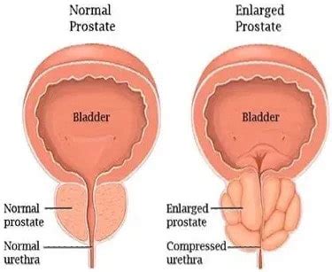 Enlarged Prostate Treatment Sydney | Benign Prostatic Hyperplasia ...