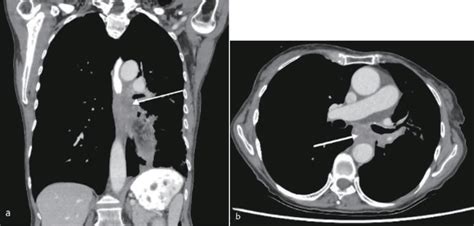 Figure From Pneumoperitoneum Post Esophageal Stent Insertion Managed