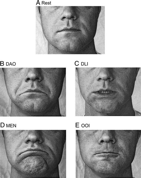 Depressor Anguli Oris Action